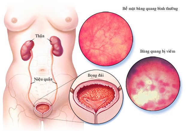 Bệnh viêm bàng quang cấp tính gây ra nhiều tác hại