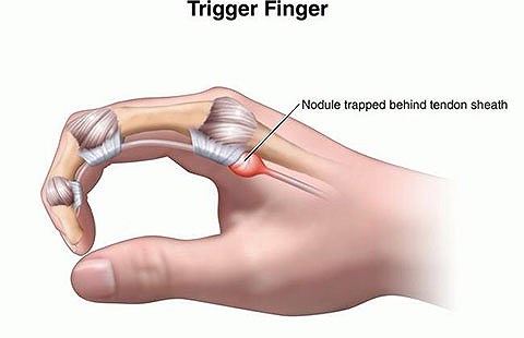 Bệnh viêm bao gân gấp ngón tay là gì