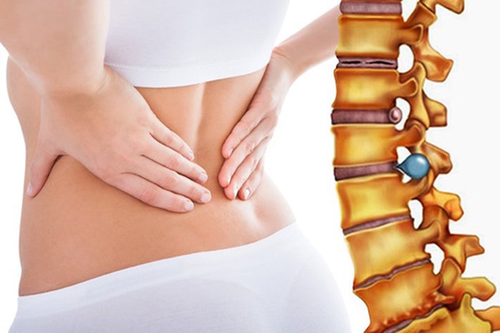 Triệu chứng của bệnh thoát vị đĩa đệm