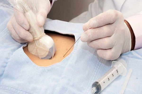Tìm hiểu về chọc ối