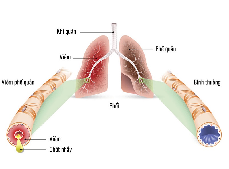 Hướng dẫn phòng bệnh viêm phế quản
