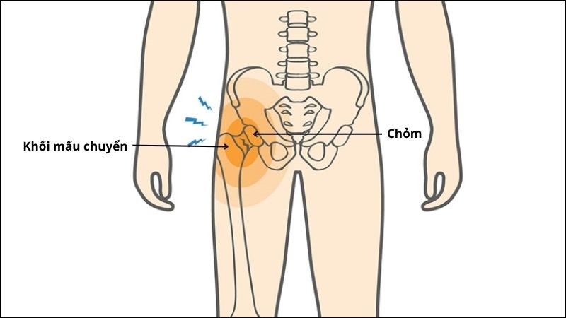 gãy mối liên khớp háng